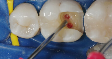 Posizionamento di MTA con il sistema MAP di Produits Dentaires (PD)