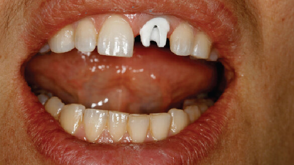 Inovativní technologie ve zhotovování náhrad na implantáty – budoucnost je tady již dnes