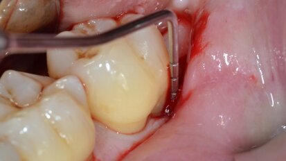 Rigenerazione tissutale guidata  su difetti intraossei profondi  con anatomia complessa