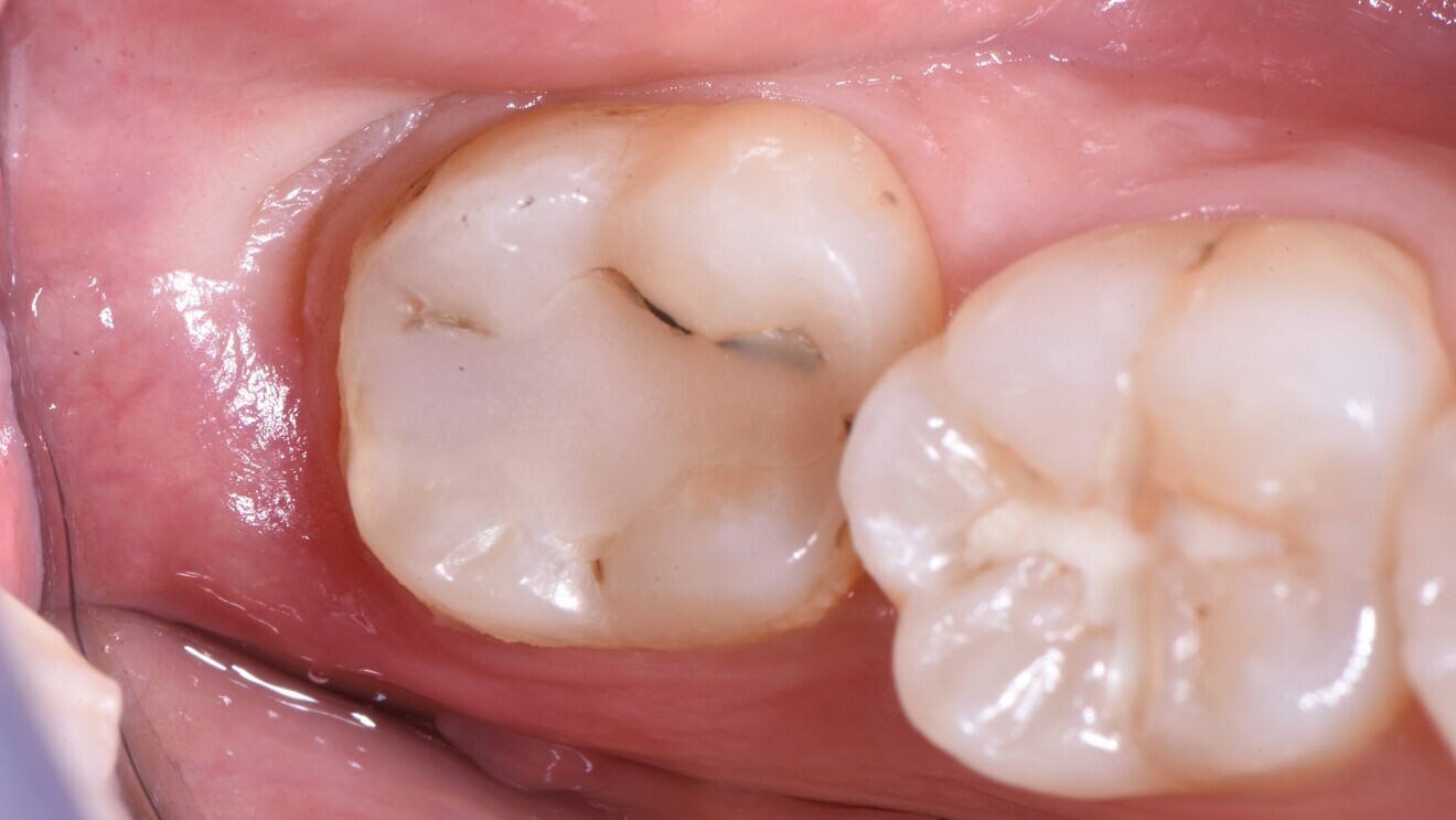 Fig. 4: Class I restoration on tooth #47 with marginal discoloration and recurrent caries prior to treatment. 