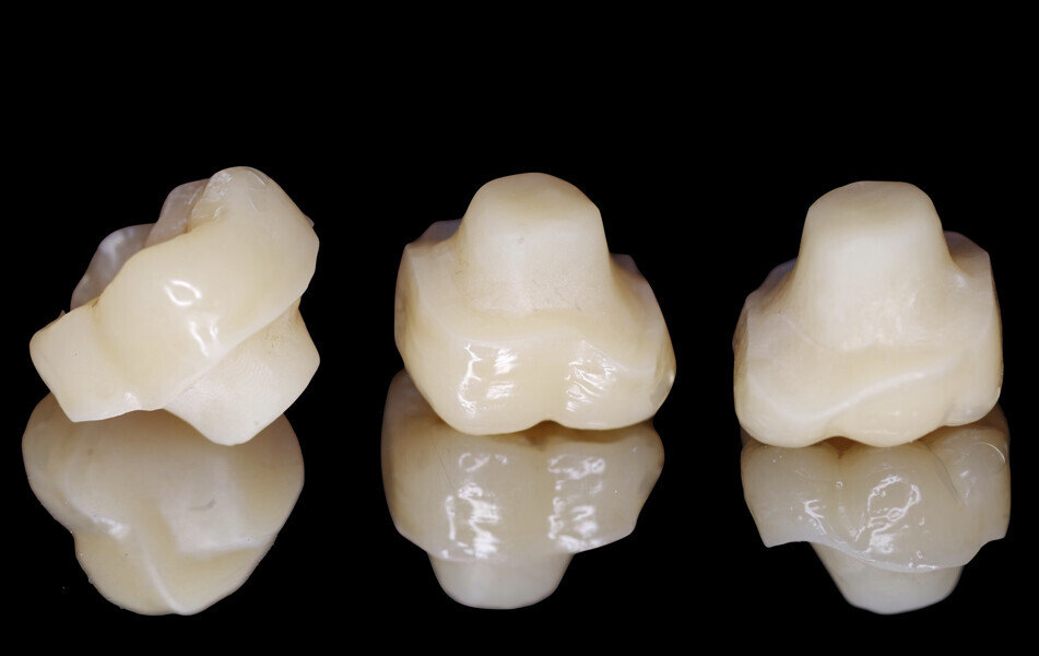 Fig. 17: Inner surface of the endocrown. Note the extensive portion for bonding in the enlarged pulp chamber preparation of the molar.