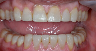 MiCD: Nepoškozujte kosmetickou stomatologií – část I.