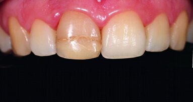 Restauration esthétique directe du secteur antérieur : concepts actuels