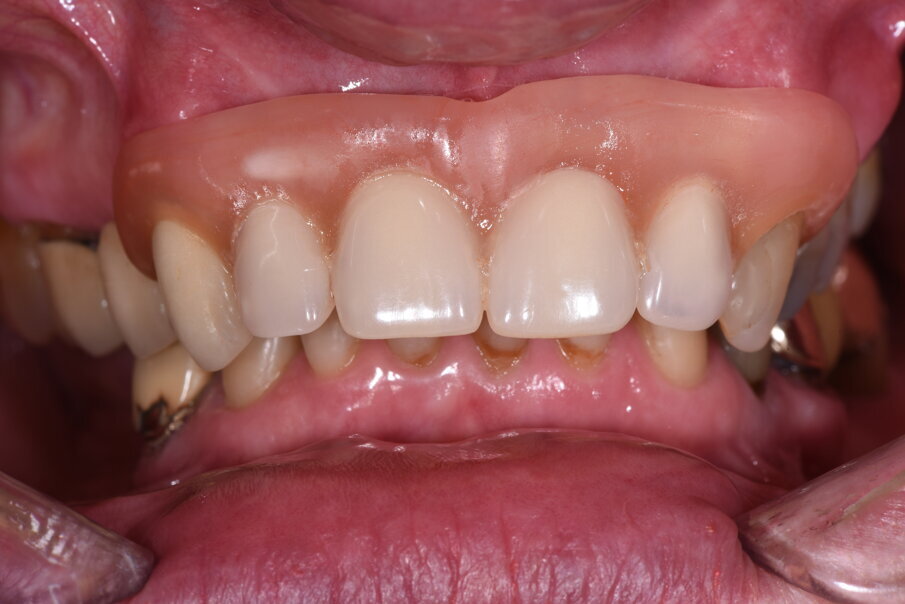 Fig. 1_Foto iniziale con il provvisorio rimovibile in posizione. La presenza di una flangia in resina consente un maggior supporto labiale.