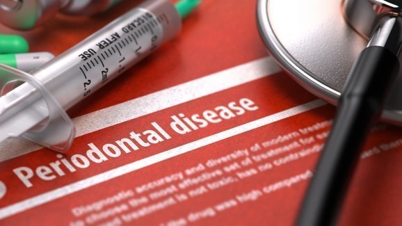 New experimental drug promises hope for those with diabetic periodontal disease