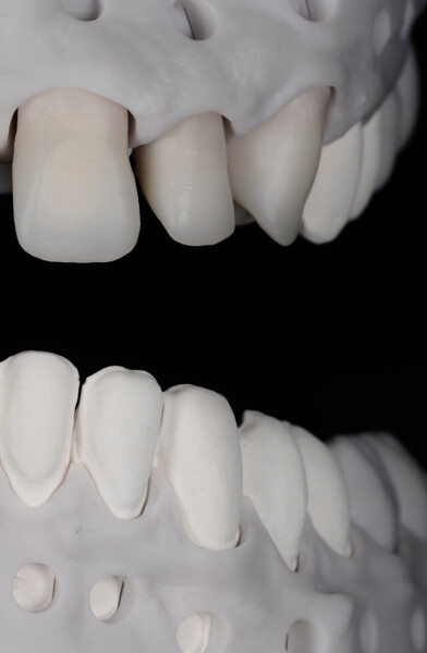 Fig. 11: Refractory dies and zirconia frameworks positioned on the model.