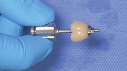 Titanium base implant cementation technique using PANAVIA SA Cement Universal
