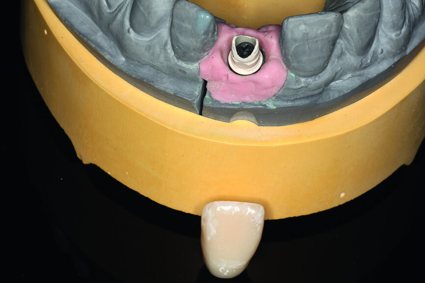 Fig. 8a: A PEEK abutment as the base for the long-term temporary restoration.