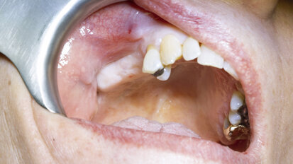 Screw-retained restoration of a maxillary first molar and second premolar