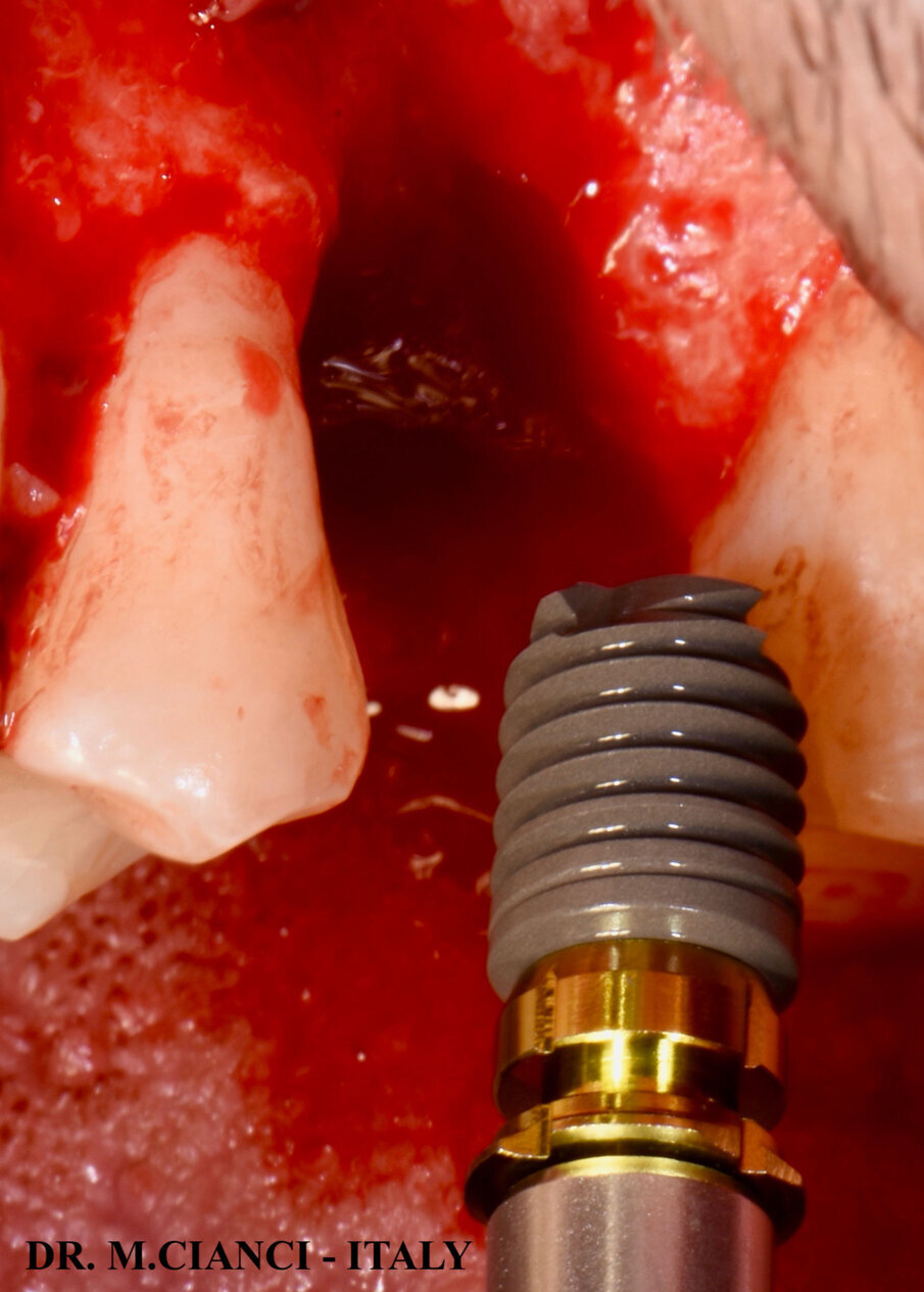 Fig. 3 - Impianto corto bti 5,5 x 7,5 mm.