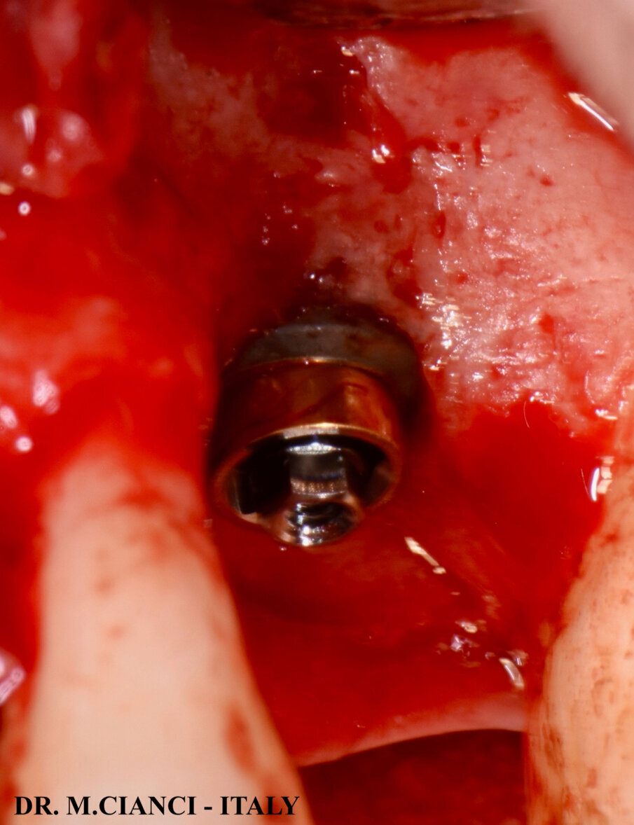 Fig. 10 - Unit 1,5 Mm - Bioblock® Concept.