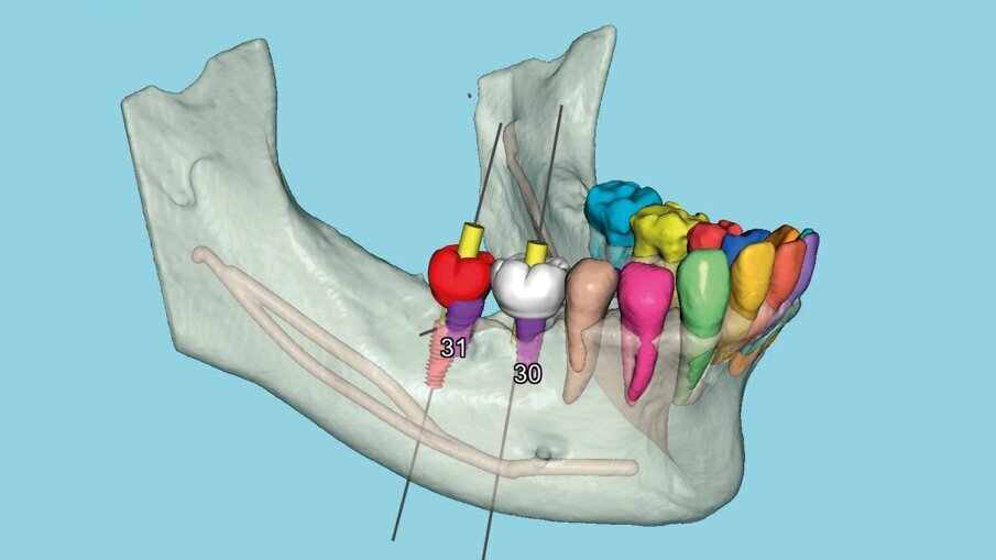 Fig. 2_Segmentazione avanzata di denti e osso guidata dall’intelligenza artificiale, combinata con trasparenze selettive e denti virtuali su impianti simulati, facilita una pianificazione protesicamente guidata.