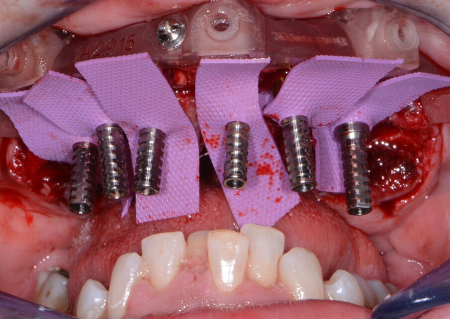 Fig. 11: Maxillary temporary cylinders isolated.