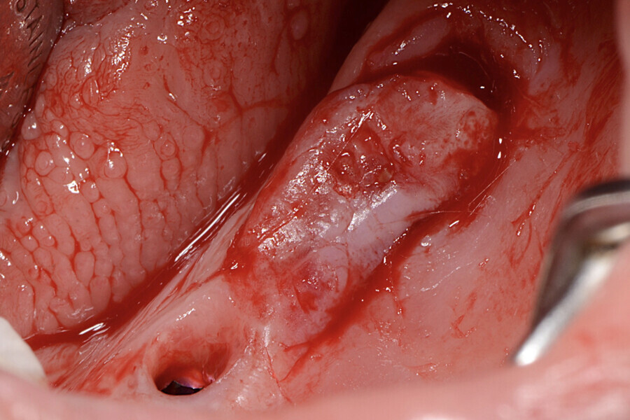 Fig.2 : Incision des bords du lambeau et désépithélialisation.