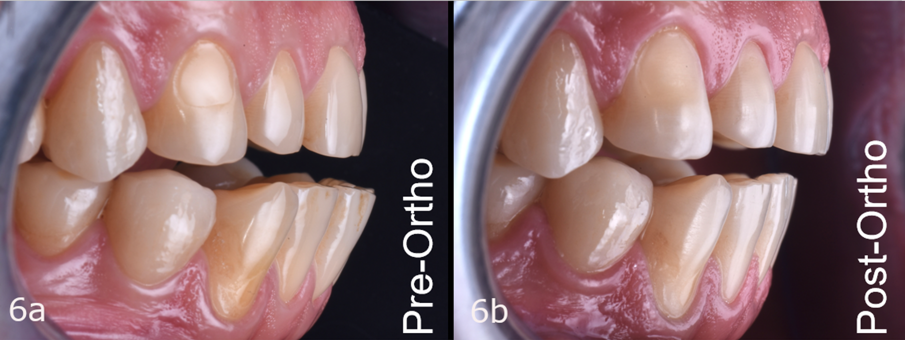 Obr. 6a,  b: Situace před a po ortodontickém ošetření.
