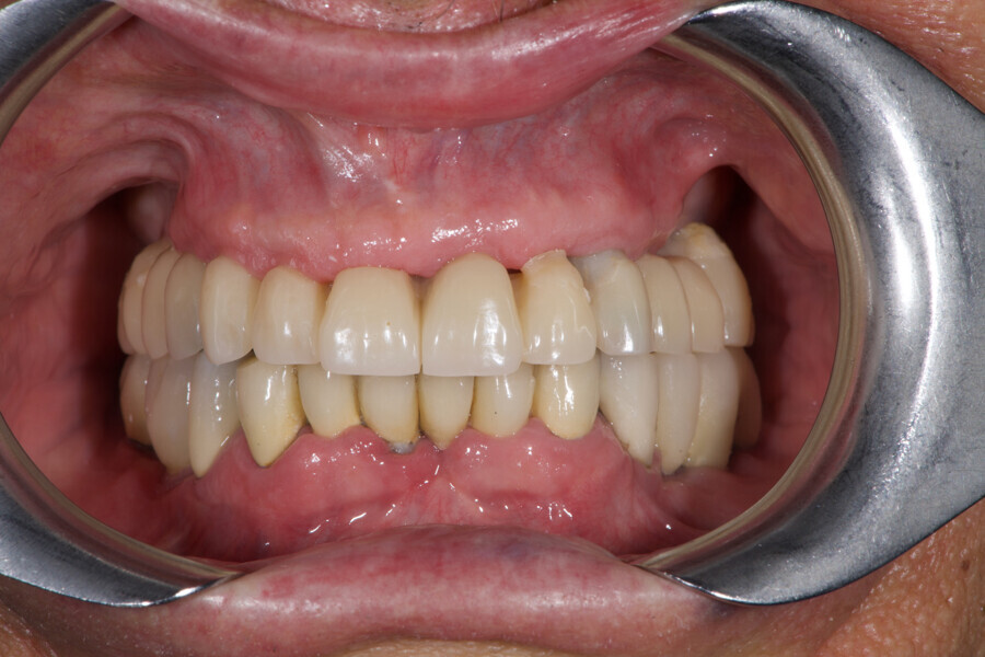 Fig. 11: Metal-reinforced temporary prosthesis in situ, frontal view.