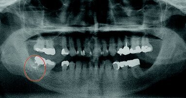 Ritrovamento di corpi estranei durante un trattamento odontoiatrico di routine