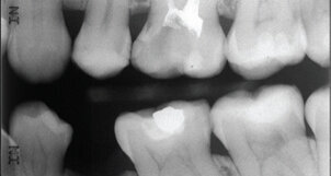 ΔΕΛΤΙΟ ΤΥΠΟΥ BiodentineTM  Βελτιωμένη κλινική εφαρμογή Ολοκληρωμένη αποκατάσταση σε μια μόνο συνεδρία