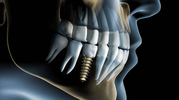 Gutachterkonferenz Implantologie des BDIZ EDI