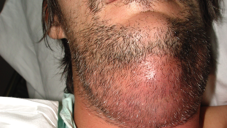 Manejo y prevención de infecciones odontogénicas