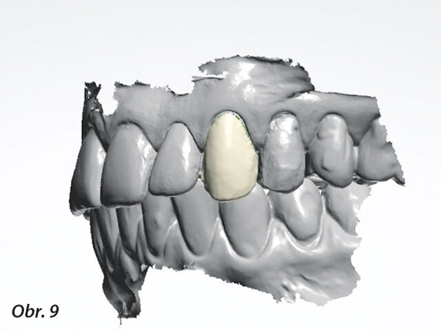 Obr. 9: Modelace náhrady (Dental System, 3Shape).