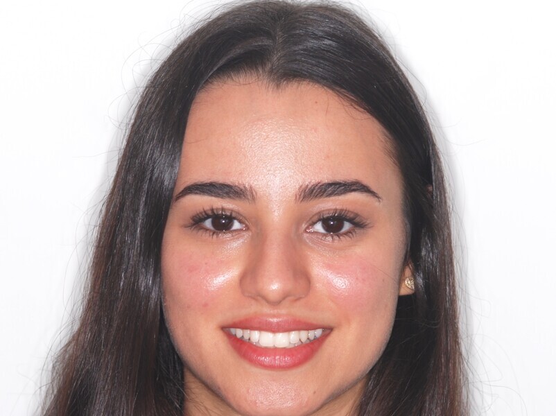 Fig. 2: Full-face frontal view after treatment.