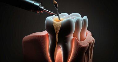 Revolutionäre Endodontie: Die Macht der Digital Geführten Therapie