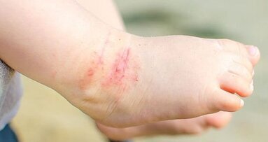 Kinderen met eczeem hebben meer kans op cariës