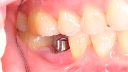 Oltre il 60 per cento dei dentisti esegue procedure di impianto dentale