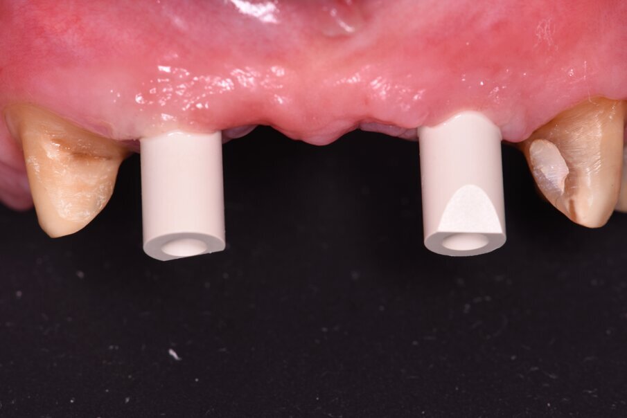 Fig. 25_Dopo opercolarizzazione si provvede a rilevare l’impronta con appositi transfer che per le impronte digitali si chiamano scan body e si differenziano per il tipo di impianto e per il tipo di scanner intraorale utilizzato.