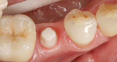 Komplexní řešení bez obsahu kovů: hybridní keramika a implantát z oxidu zirkoničitého