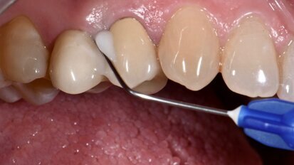 Effetti clinici dell’applicazione sottogengivale di un gel a base di Xantano e Clorexidina nel trattamento delle malattie peri-implantari