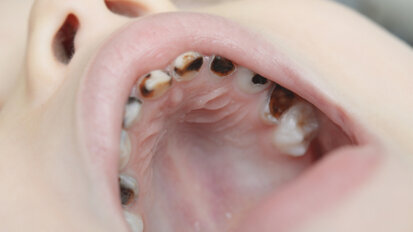 Early preventive dental care may not reduce caries risk