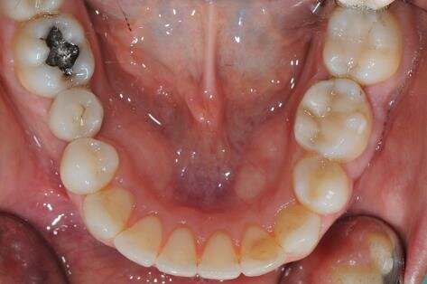 Figg. 6a-6d - Foto intraorali post-trattamento: visioni frontale (a), laterali (b), occlusali (c, d).