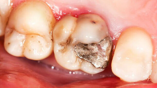 In odontoiatria niente diritto di ingresso per l’amalgama