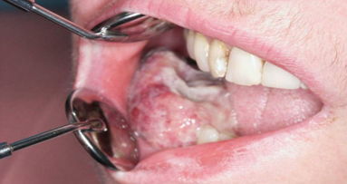 Идентифицирана е причината за разпространението на оралния карцином