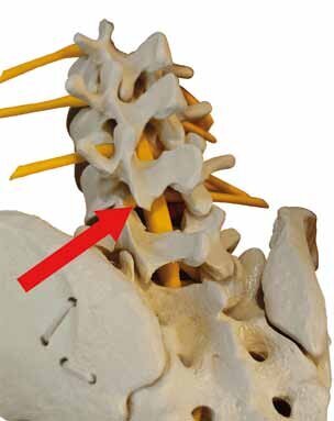 Fig. 1: Poor posture opens the facets and the discs starts to degenerate and prolapses may appear.