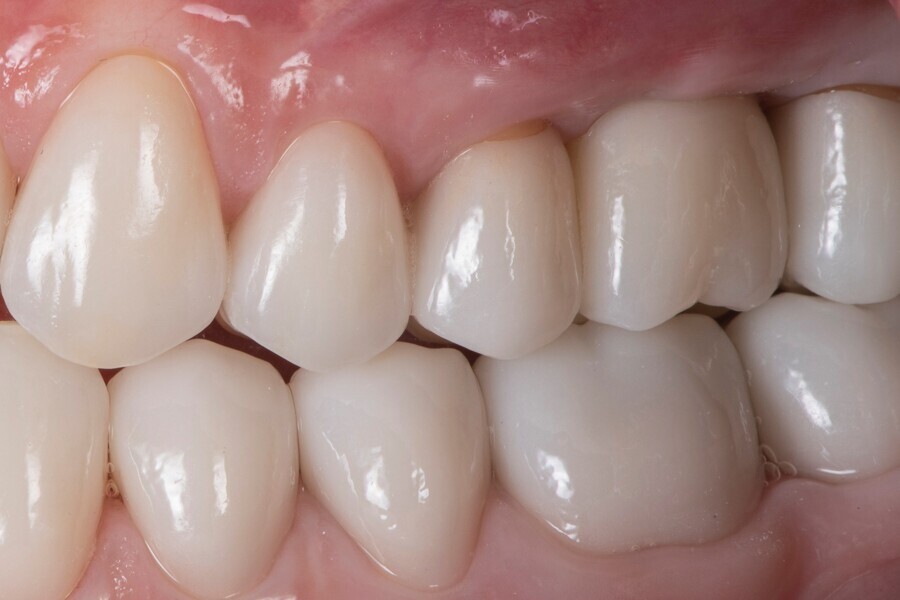 Fig. 2e: Buccal view of the gingiva after relaxation of the bleaching.