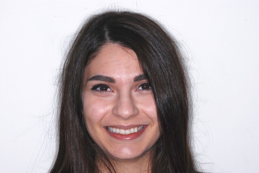 Fig. 14: Full-face frontal view after treatment.