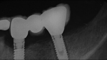 Jednoznačná indikace CBCT v distální části mandibuly