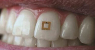 Novo dente montado em microchip rastreia alimentos ingeridos