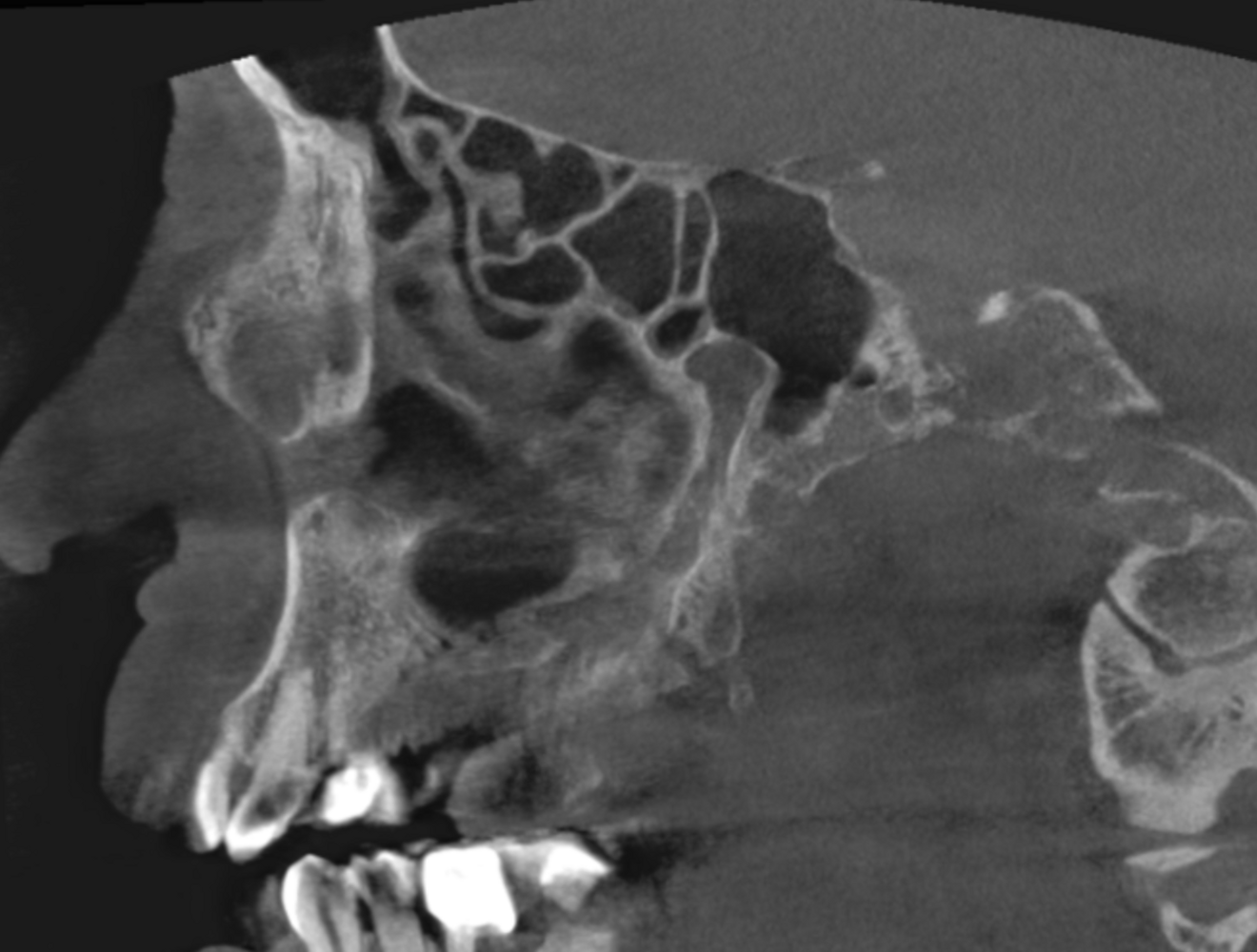 Fig. 7: Large-volume CBCT scan, sagittal view 12 weeks later showing the fully healed paranasal sinus area.
