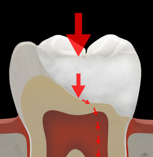 Fig. 39b: Schematic representation of the stress distribution in a typical tooth crown (a) and in a crown restoration of a molar without a fibre-reinforced membrane (b) and with a fibre-reinforced membrane (c).