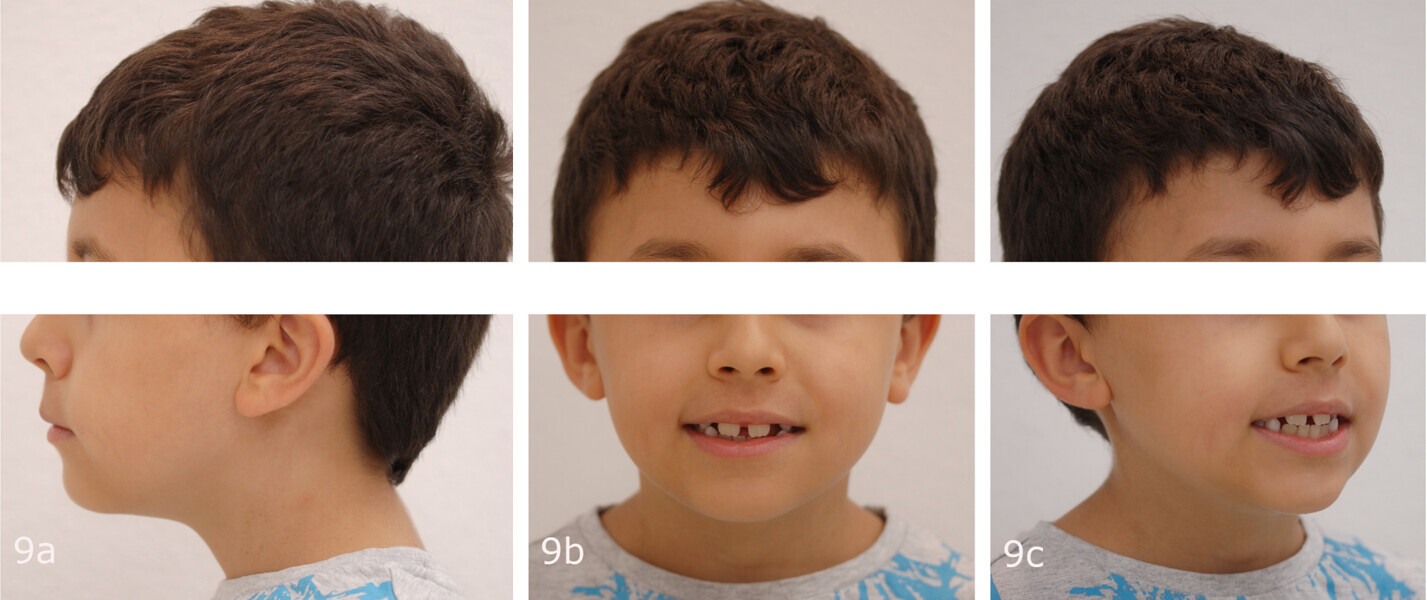 Figs. 9a–c: Comparison of the extra-oral photographs at the (a–c) start and (d–f) end of treatment.