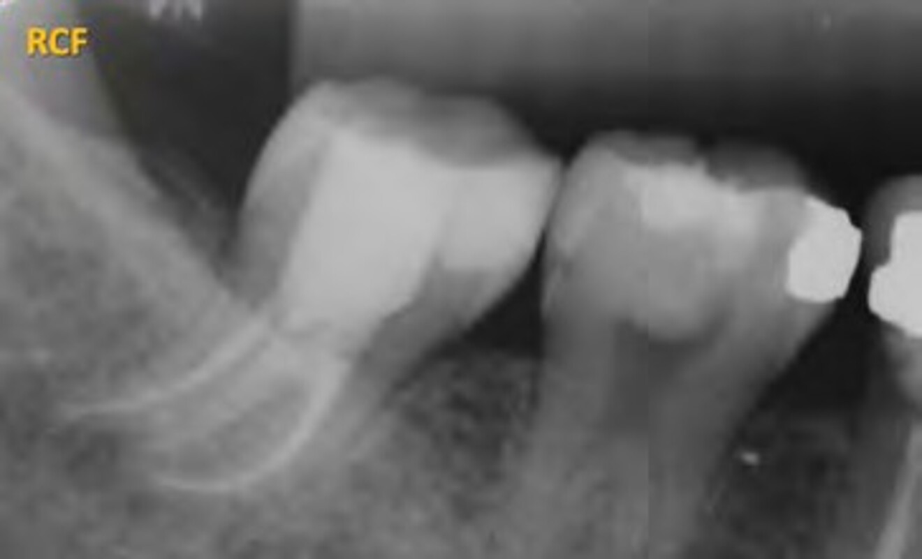 Fig. 2a: Immediate postoperative periapical radiograph demonstrating satisfactory obturation of the C-shaped root canal system and coronal restoration following nonsurgical root canal treatment.