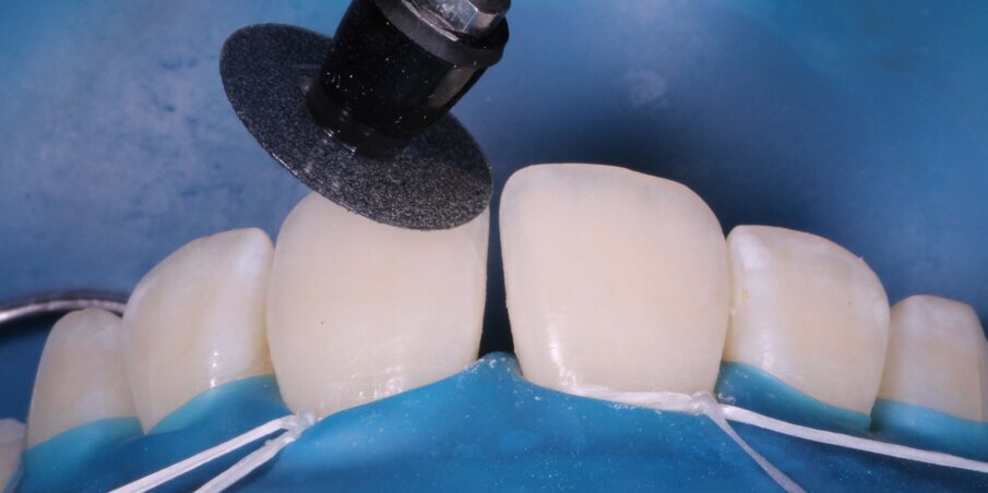 Fig 4. Isolation and aprismatic enamel removal with coarse disc