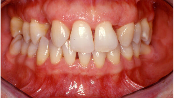 Il ruolo dell’ortodonzia nei trattamenti interdisciplinari