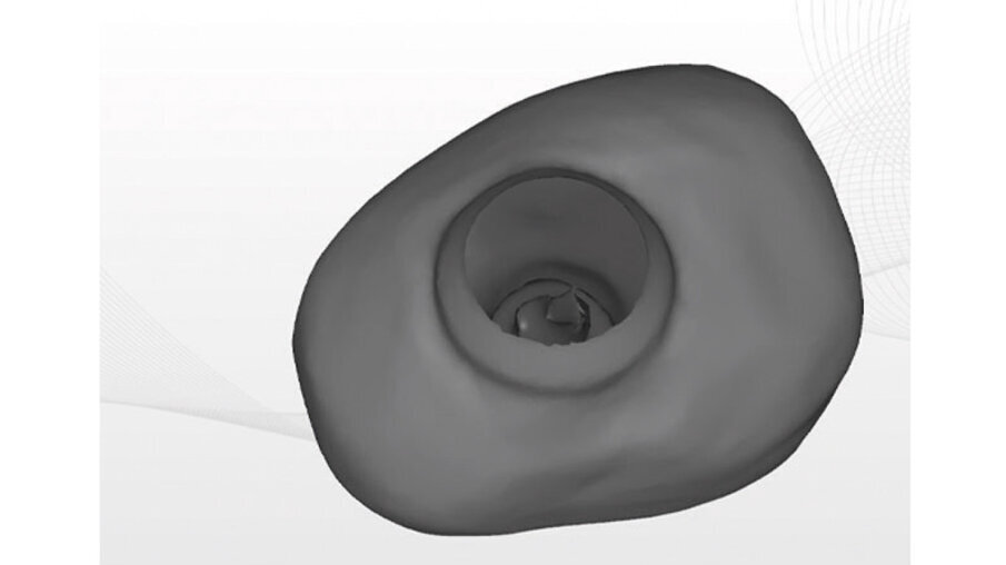 Figg. 8a-8c_Progettazione CAD della vite di guarigione customizzata.