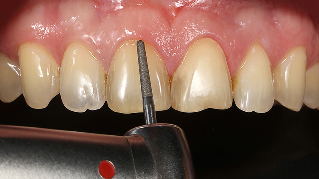 Fig. 5. Preparación mínimamente invasiva durante la creación de un microchámfer en la zona cervical.