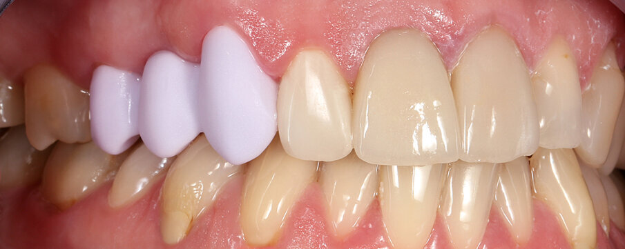 Fig. 28: Try-in of the ground monolithic bridge whilst still in the pre-crystallized state